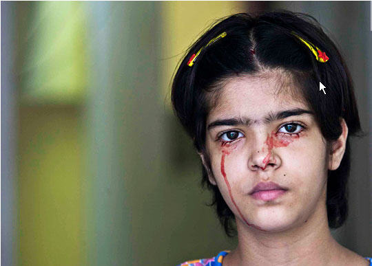 young girl bleeding from her face