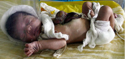 infant with heart and liver outside of body