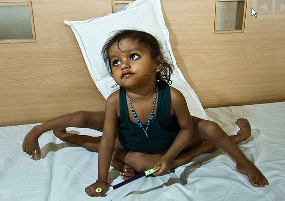 child with eight limbs